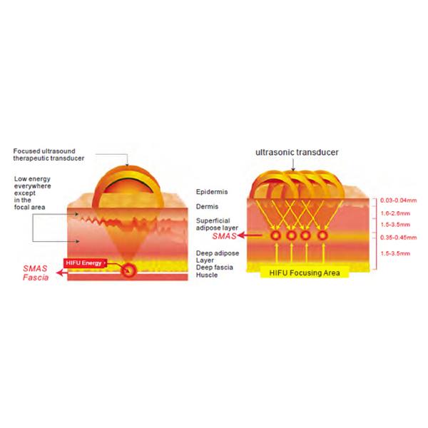 Anti Aging Hifu Face Lifting Machine Wrinkle Removal 10 - 11 Lines Adjustable