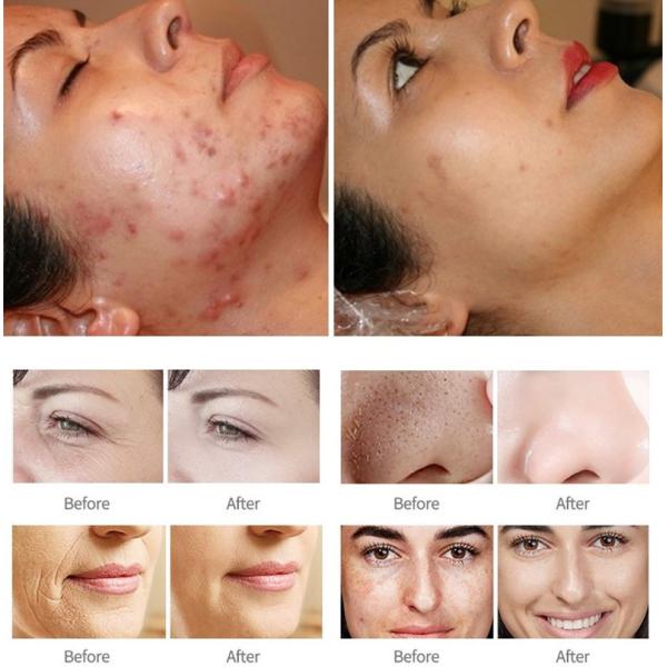 14 en 1 machine de peeling à jet d'oxygène multifonctionnelle pour les soins de la peau