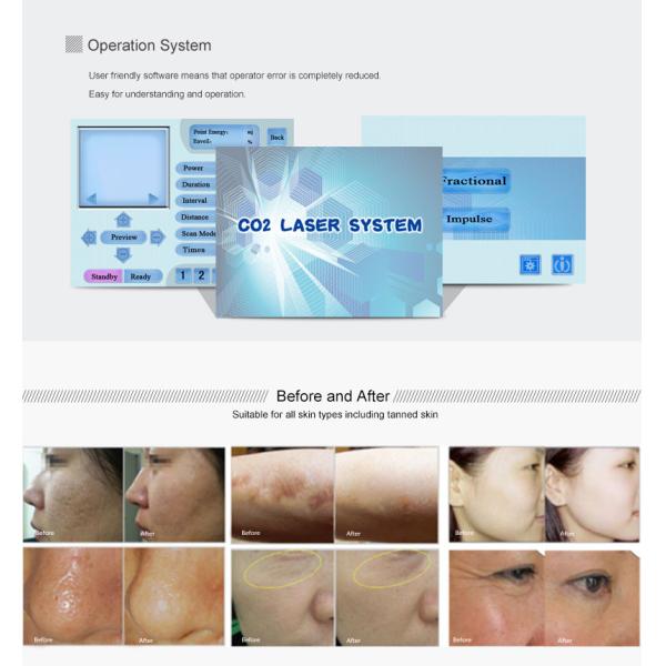 High Efficiency Co2 Fractional Laser Machine 10600nm Wavelength CE Certification