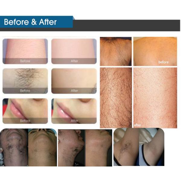 Spa Salon 20HZ 808 Diode Laser Hair Removal Machine