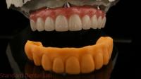 5 ans de garantie Implantation dentaire couronne PMMA pont sur plusieurs unités abutments personnalisé Vita Shade