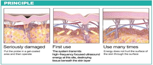 Ультразвук 2 фокуса подниматься стороны в 1 машине Липо 3Д ХИФУ