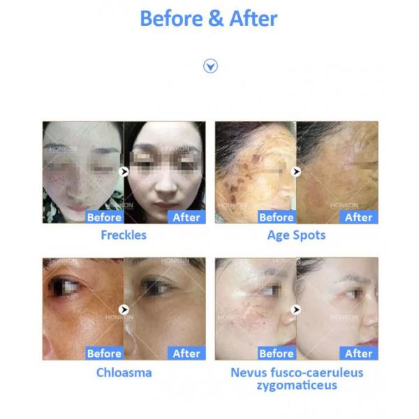 Nd Yag машины удаления татуировки лазера пикосекунды 532nm 1064nm