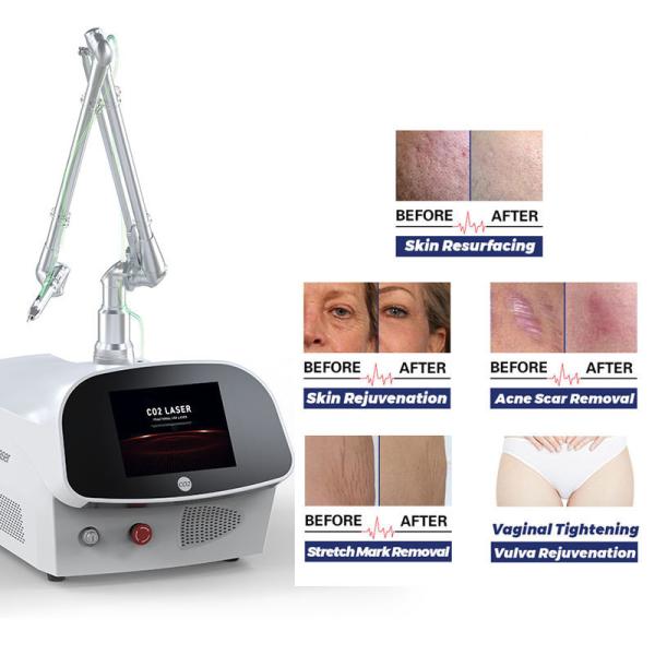 Máquina fracionária 635nm do laser do CO2 do tubo de vidro para a remoção da acne da marca de nascença da pele