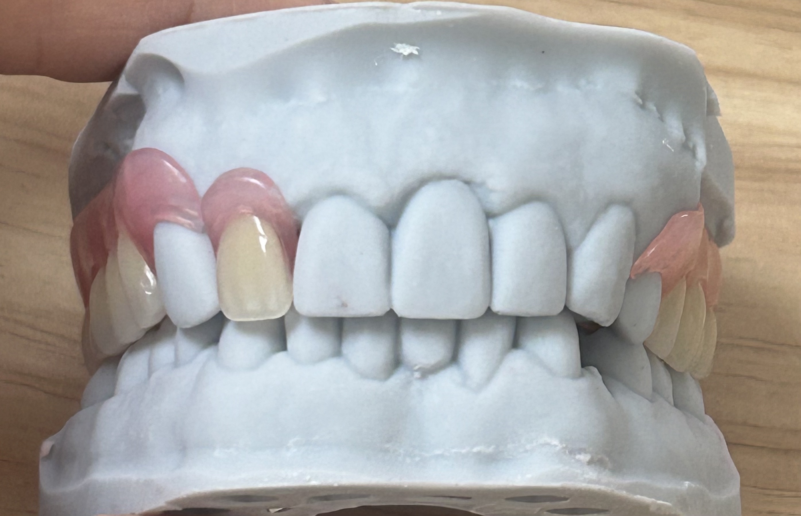 Lightweight Comfortable Discreet Appearance Flexible Removable Denture and Invisible Removable Denture Base