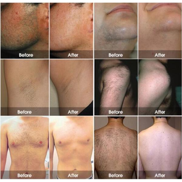 808 810nm Diode Laser Hair Removal Machine For Dark Skin High Performance