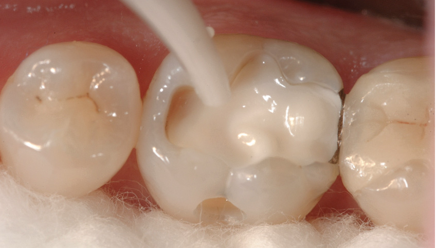 Filler Content 77% Light-Curing Nano-Composite Restoration Resin