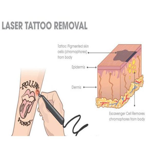 Tattoo Removal ND YAG Laser Machine