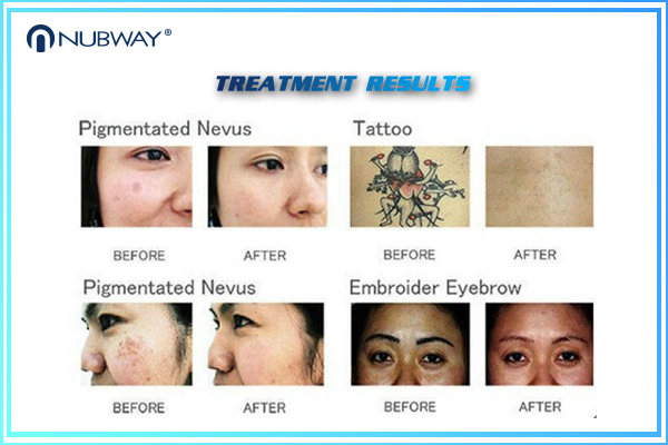 2019 New Design Picosecond Laser Tattoo Removal Machine