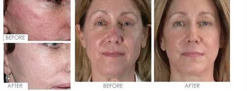 Professional Spider Vein Removal Machine Effective Powerful 30w Skin Treatment Machine