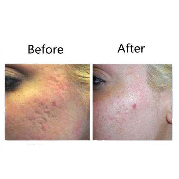 Máquina fraccionaria 10600nm del laser de Vaginal Tightening Co 2 inmóviles