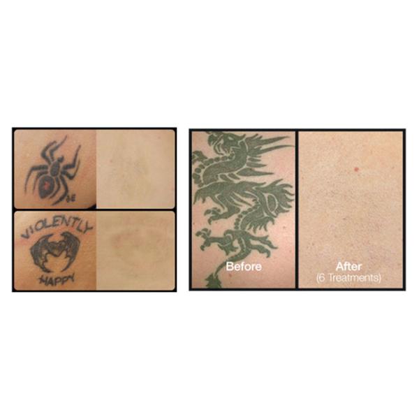 1064nm 532nm ND YAG Laser Tattoo Removal Machine Pigmentation Freckle Removal