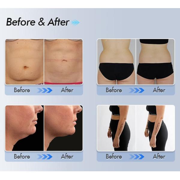 Новое жирное тело потери уменьшая холодную жирную замерзая красоту тела 360 градусов ваяя уменьшая машину