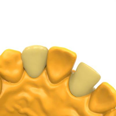 Biocompatible Permanent Crown Bridge Resin Hot Deformation Temperature 80C Bending Strength 180-208 Mpa