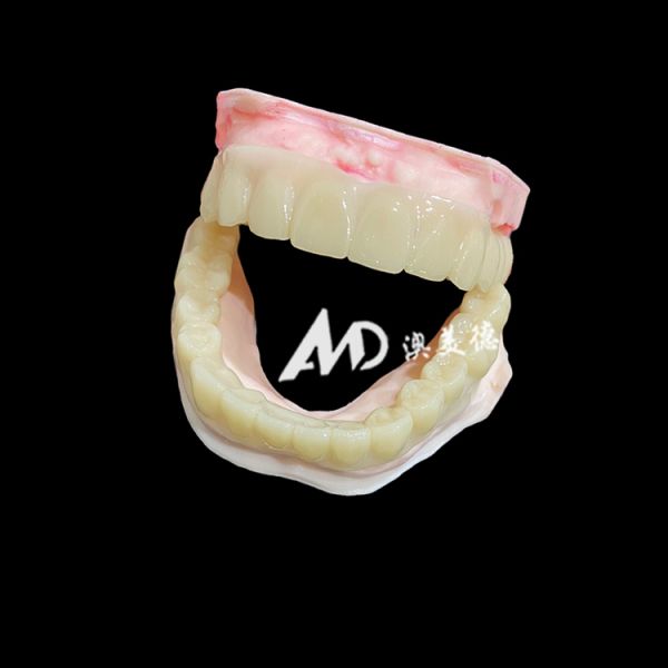 Lightweight PMMA Temporary Bridges with Hollow Design for Implant Restorations