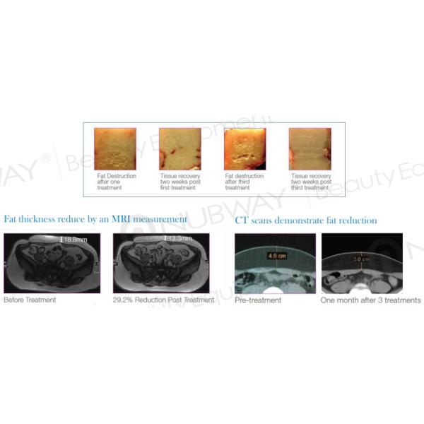 New beauty equipment 13mm focus depth hifu cellulite reduction body weight measuring machine with 10 inch touch screen