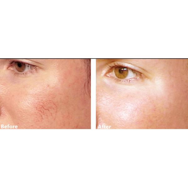 машина удаления волос лазера диода 980nm, вена спайдера и машина удаления Vasuclar