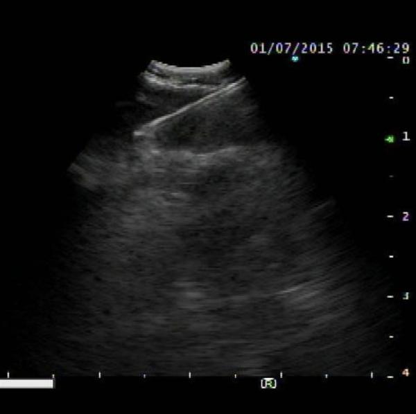 ExpectTM Ecografía pulmonar-endobronquial Aguja de aspiración transbronquial