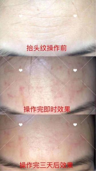 Beauty Equipment Hot Sale Fractional Rf Microneedle Skin Solution Beauty Tighten Machine