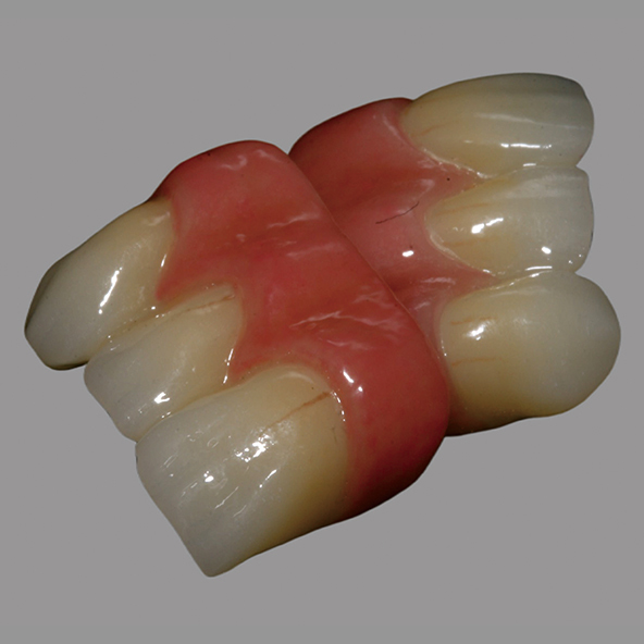 Digital Design Dental Lab | CAD / CAM Dental Layered Zirconia Bridge With Pink Porcelain