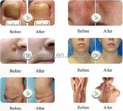 Ногтя лазера диода клиники 980nm удаления GOMECY обработка васкулярного грибная