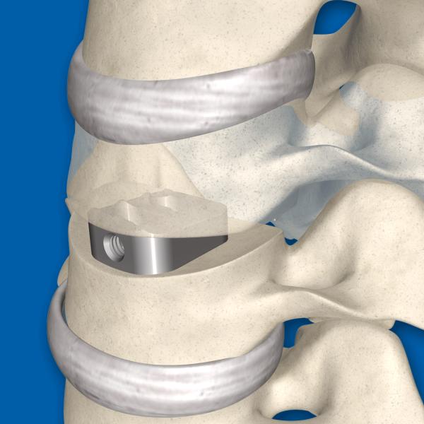 Durable Cornerstone Peek Cage Perforated Structure For Bone Ingrowth / Throughgrowth