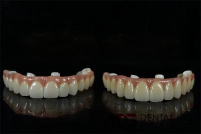 Biocompatible Titanium All On 6 Dental Implants Bridge For Tooth
