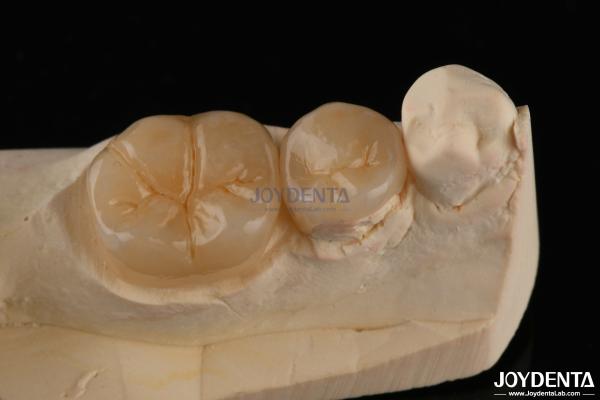 Les incrustations et les incrustations dentaires Emax résistant aux fractures 1,5 mm faible translucide