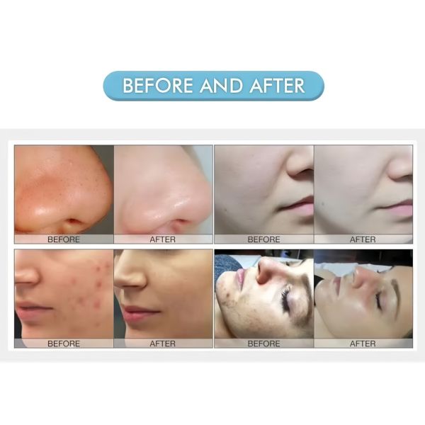 6 In 1 Oxygen Hydra Facial Machine Visible Pore Cleaning RF Lifting Skin Care System