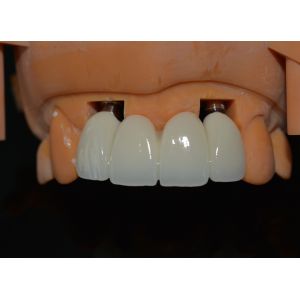 Прочность за нашим успехом наши техники кроны зубного имплантата