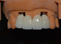 La fuerza detrás de nuestro éxito nuestros técnicos de la corona del implante dental