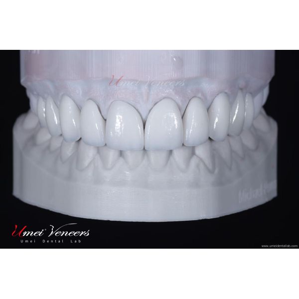 Customized ultra-thin dental veneer
