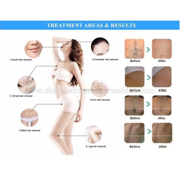 Stationary Opt Shr Hair Removal Machine Skin Whitening Beauty Equipment