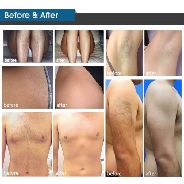 Machine d'épilation laser à diode de haute puissance portative 755 808 1064 nm 808 nm