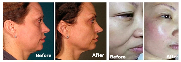 Skin Salon HIFU Beauty Machine , Body Shaping HIFU Ultrasound Machine Painless