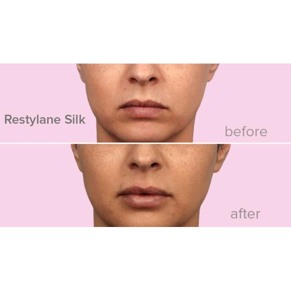 Инъекционный лифт Лидо Гиалуроновая кислота Dermal Filler уменьшает морщины и складки на лице