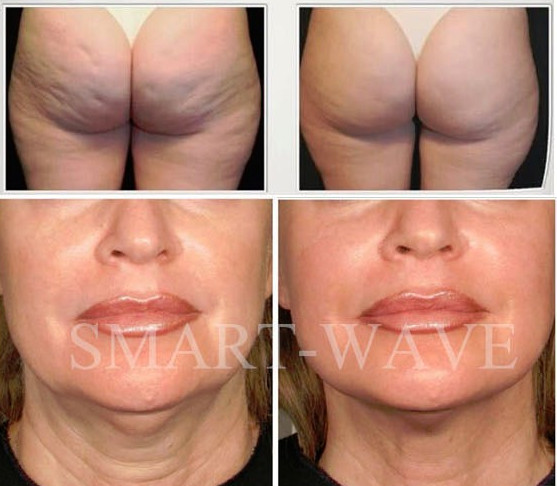 Машина терапией акустической волны обработки целлюлита, оборудование шоковой терапии