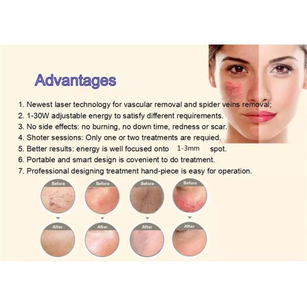 Удаление пауковых вен с 980-нм диодным лазером