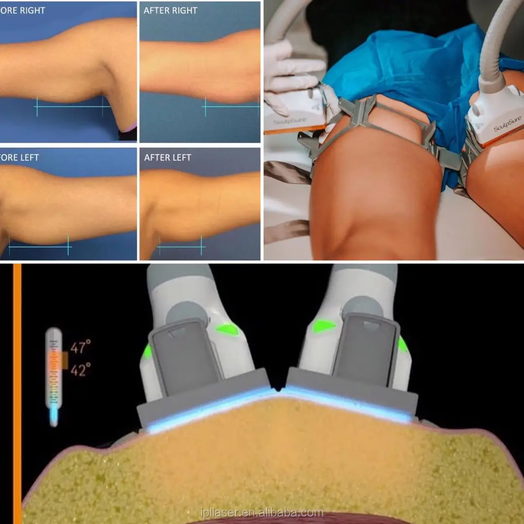 1060nm diode laser sculpsure body contouring fat freezing slimming system for fat loss