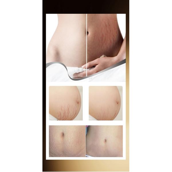 Aceite de masaje de almendras para estrías, esencia reparadora para el embarazo y el parto