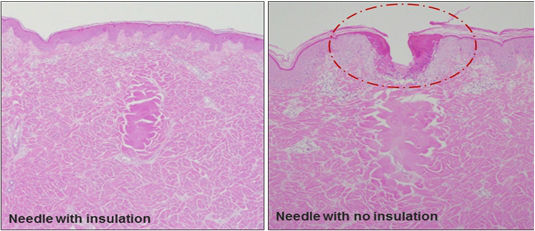 5mhz Touch High Quality Screen Thermage Skin Treatment Machine Nubway