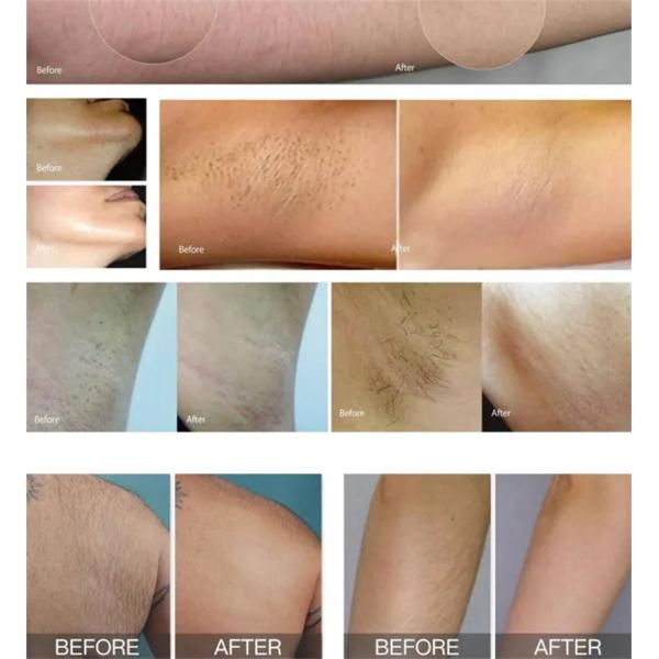 Máquina 500w 1600w del retiro del pelo del diodo láser de 808 nanómetro Yag para la cara y el cuerpo