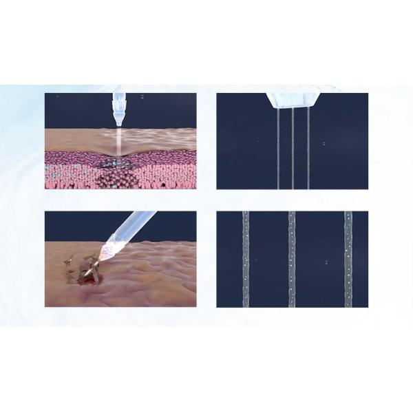 High Pressure Hydra Peeling Hydrotherapy Machines for Deep Cleansing and Rejuvenation