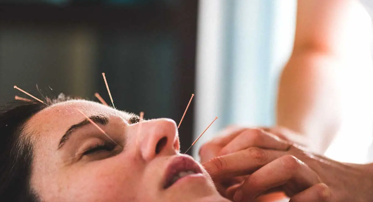 Medical Grade Sterile Disposable Acupuncture Needles Individually Packaged for Body and Facial Use
