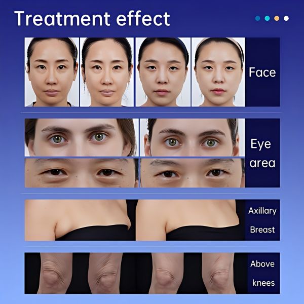 Non Invasive 3D HIFU Machine , High Intensity Focused Ultrasound HIFU Body Machine