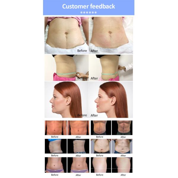 5 Handles Cryotherapy Slimming Machine , Cryotherapy Weight Loss Machine