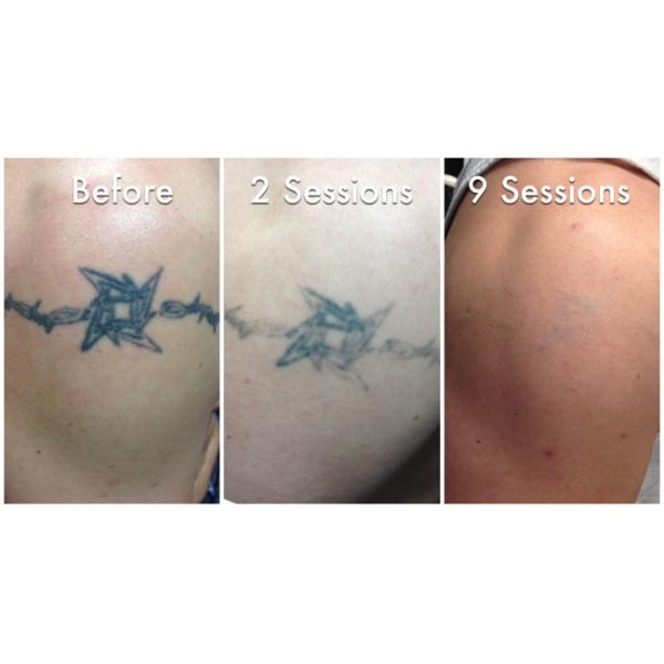 750ps Picosecond ND YAG Laser Tattoo Removal Machine For Embroider Lip Tattoo