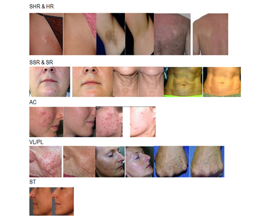 Портативная машина удаления волос SHR личная для системы охлаждения льда обработки женщин