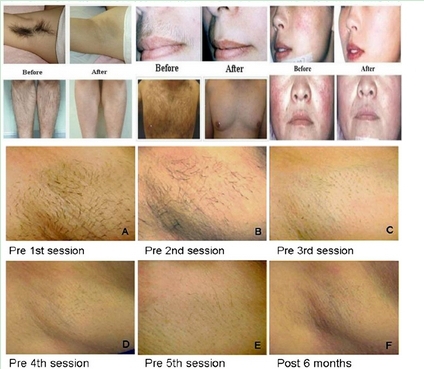 Salon Equipment IPL Photofacial Hair Removal Treatment Machine / IPL