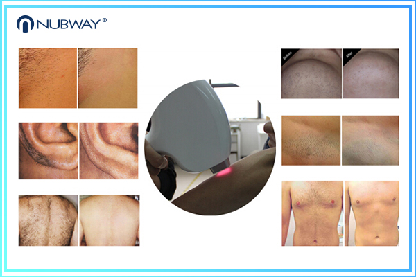 600W strong Power!!! 808nm diode laser hair removal machine /diode laser hair device / diode laser alexandrite